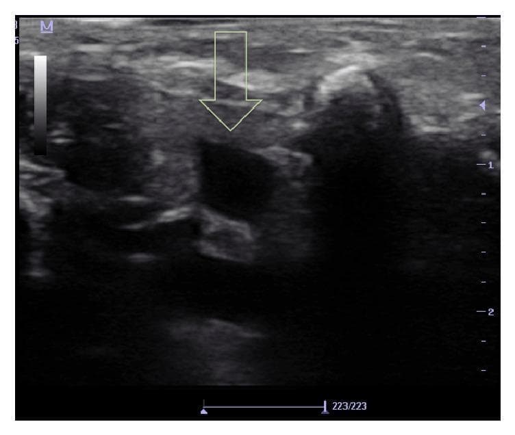 This diagnostic ultrasound image captures a transverse cross-sectional view of the supraclavicular region in a neonate, specifically for the purpose of central venous cannulation. The primary focus is the subclavian vein (SCV), indicated by a yellow arrow. The SCV appears as a prominent, anechoic, oval-to-circular structure in the center of the frame, signifying its fluid-filled lumen. Immediately posterior and lateral to the vein are heterogenous soft tissues and the hyperechoic borders of the subclavian artery. The imaging displays depth markers on the right vertical axis, indicating a shallow field appropriate for neonatal anatomy, and a grayscale calibration bar on the top left. This visual serves as a procedural guide for real-time ultrasound-guided vascular access, demonstrating the supraclavicular approach which is utilized when anatomical challenges like edema or a short neck limit access to the internal jugular vein. The moderate resolution allows for the differentiation of the target vessel from surrounding musculoskeletal landmarks and deeper pleural surfaces, which are critical for avoiding complications such as pneumothorax.