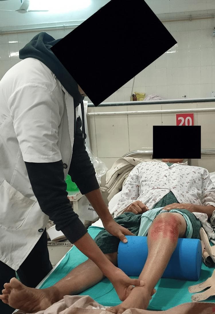 This clinical photograph illustrates a procedural rehabilitation technique for strengthening the vastus medialis oblique (VMO) muscle. A patient is depicted in a supine position on a hospital bed with a cylindrical blue foam bolster placed underneath the popliteal fossa of the right knee. The patient's right lower extremity shows visible signs of trauma, specifically a large, erythematous area of skin abrasion or friction burn across the anterior knee and proximal tibia. A clinician, dressed in a white medical coat, is shown providing manual assistance and tactile feedback, with one hand stabilizing the knee over the bolster and the other supporting the distal leg/ankle to facilitate terminal knee extension or isometric quadriceps contraction. This visual serves as a demonstration of post-injury physical therapy and musculoskeletal rehabilitation following soft tissue trauma or ligamentous injury, such as a posterolateral corner (PLC) injury. The clinical focus is on the correct positioning of props and clinician-led guidance for therapeutic exercise in an acute or subacute inpatient setting.