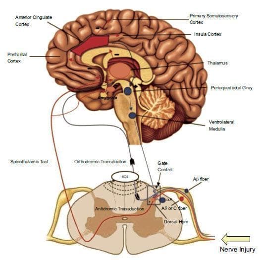 This pathophysiology diagram illustrates the neural pathways of nociceptive processing and the mechanisms of spinal cord stimulation (SCS). The graphic features a sagittal cutaway of the human brain and a cross-section of the spinal cord. Key intracranial structures labeled include the prefrontal cortex, anterior cingulate cortex (highlighted in red), primary somatosensory cortex, insula, thalamus, and amygdala. The brainstem is detailed with the periaqueductal gray and ventrolateral medulla, indicating the descending inhibitory system. At the spinal level, the diagram shows the dorsal horn and its interaction with Aβ and Aδ/C nerve fibers following a 'nerve injury'. The visual highlights the ascending spinothalamic tract and descending pathways that facilitate segmental spinal inhibition. Key physiological concepts depicted include gate control theory, orthodromic and antidromic transduction, and cortical modulation. This educational material is designed to demonstrate how neuromodulation through SCS impacts pain signaling and inhibitory feedback loops between the peripheral nervous system and the central nervous system.
