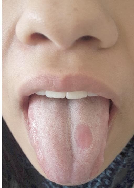 A clinical photograph of a human tongue demonstrating a classic presentation of median rhomboid glossitis, appearing in a slightly paramedian location. The tongue surface shows a pinkish-white background with a rough texture consistent with normal papillation. In the posterior-middle third of the dorsal surface, there is a well-circumscribed, oval-shaped erythematous lesion approximately 1 cm in diameter. This lesion is characterized by a smooth, depapillated surface (atrophy of the filiform papillae) that contrasts sharply with the surrounding healthy tissue. The lesion is positioned slightly to the patient's left of the midline. This visual is typical for oral medicine and dermatology studies focusing on benign inflammatory conditions of the tongue, often associated with chronic candidiasis. The photograph is suitable for medical education on oral pathology and differential diagnosis of lingual lesions.