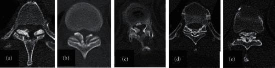 This set of axial CT images illustrates Sato's classification of Thoracic Ossification of the Ligamentum Flavum (TOLF), a pathological condition where the ligamentum flavum undergoes heterotopic ossification, leading to spinal stenosis. The images are categorized into five distinct types based on morphology: (a) Lateral type: Ossification is localized at the capsular portion of the ligamentum flavum. (b) Extended type: The ossification expands from the lateral aspects toward the midline while remaining thin. (c) Enlarged type: The ossified mass becomes more substantial and projects further into the spinal canal. (d) Fused type: The bilateral ossified masses meet and fuse at the midline. (e) Tuberous type: A prominent, nodular, or beak-like ossified growth that significantly narrows the spinal canal. Each panel demonstrates the varying degrees of posterior spinal canal encroachment and the spatial relationship between the ossified ligament and the adjacent vertebral lamina. This classification is clinically significant for determining the severity of canal narrowing and planning surgical decompression strategies in the thoracic spine.