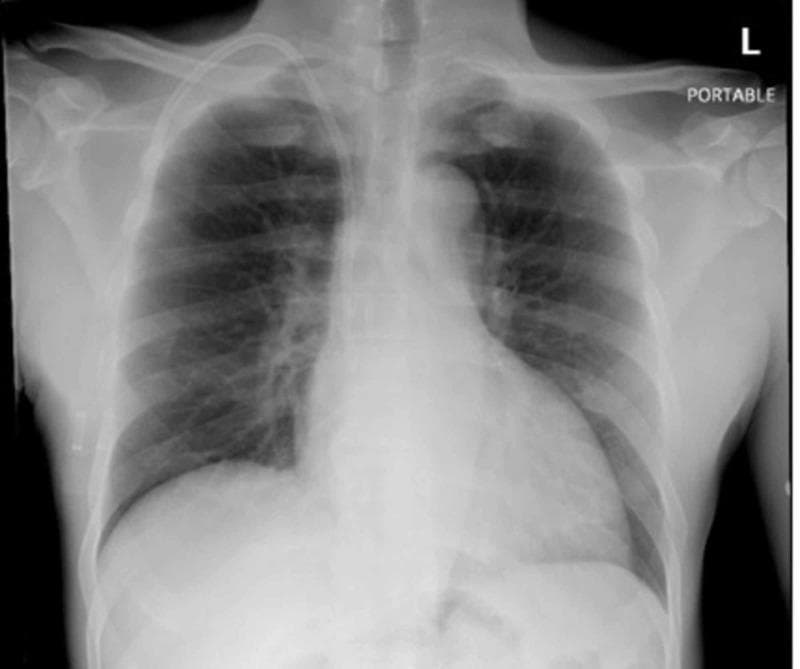 This diagnostic image is a front-on chest radiograph (X-ray), labeled as a portable study, demonstrating the placement of a right internal jugular dialysis catheter. The radiopaque catheter is seen entering via the right neck, coursing inferiorly through the superior vena cava. The distal tip is correctly positioned, projecting at the right cavoatrial junction. The anatomical structures, including the cardiac silhouette, mediastinum, and hila, appear within normal limits. The lung fields are clear bilaterally with no evidence of focal consolidation, pleural effusion, or pneumothorax. Bony structures, including the ribs, clavicles, and scapulae, are unremarkable. This radiograph serves as a clinical evaluation for catheter tip placement and to rule out acute cardiopulmonary complications, such as infectious processes or procedural trauma, in a patient with end-stage renal disease (ESRD).