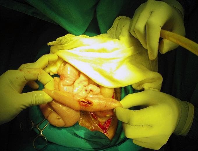 This clinical photograph shows an intraoperative view of an exploratory laparotomy, demonstrating a bowel perforation in the context of typhoid fever (Salmonella Typhi). The image focuses on a loop of small intestine held by a surgeon's gloved hands, revealing a discrete, longitudinal perforation with hyperemic and slightly everted edges. The surrounding serosa exhibits generalized inflammation and congestion. In the background, other segments of the intestine appear edematous and pale-pink, with visible white-yellowish peritoneal nodules and purulent exudate suggestive of concurrent miliary peritoneal tuberculosis and secondary peritonitis. Surgical instruments, suction tubing, and green sterile drapes define the surgical field. This image serves as an educational example of the severe gastrointestinal complications of typhoid fever, specifically intestinal perforation, and illustrates the challenging clinical scenario of co-infection with tuberculosis in an acute surgical setting.