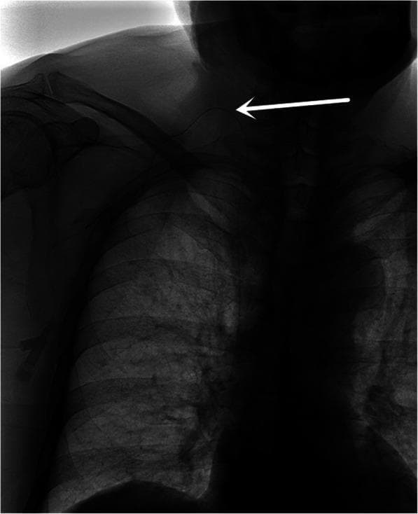 Anteroposterior (AP) chest X-ray radiograph demonstrating the placement of a Totally Implantable Venous Access Device (TIVAD) via the right internal jugular vein (IJV). The radiopaque catheter is visible entering the soft tissues of the right neck, crossing over the medial third of the right clavicle, and descending toward the superior vena cava. A prominent white arrow indicates a sharp acute angle or folding point where the catheter traverses the clavicle, reflecting potential mechanical stress or kinking due to a high puncture site. Anatomical structures including the right clavicle, ribs, and mediastinal shadow are visualized. This image serves as a clinical example of procedural outcomes and potential catheter complications, such as bending or restricted flow, associated with the IJV approach for venous port implantation.