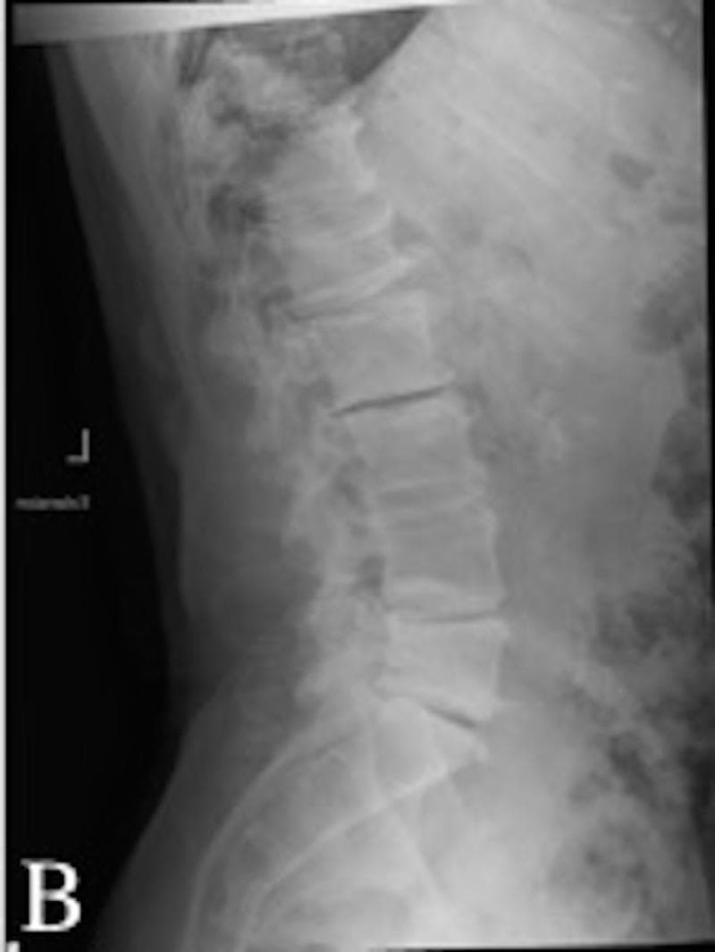 This lateral lumbar spine X-ray demonstrates advanced degenerative changes and scoliotic deformity in a 56-year-old patient. Key findings include significant multilevel intervertebral disc space narrowing, particularly prominent in the mid-to-lower lumbar segments, indicating chronic disc degeneration. Extensive anterior and lateral osteophyte formation is visible along the margins of the vertebral bodies. There is evidence of facet joint arthropathy characterized by sclerosis and hypertrophy of the posterior elements. The spinal alignment shows a loss of normal lumbar lordosis and malalignment suggestive of degenerative scoliosis, with vertebral body rotation and tilting. The combined findings are consistent with multilevel central canal and neuroforaminal stenosis, typical of complex adult spinal deformity secondary to degenerative joint and disc disease. This imaging serves as an educational example of progressive spondylosis and its impact on sagittal spinal balance.