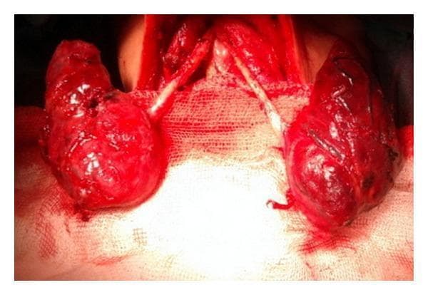 This clinical photograph captures an intraoperative view of the neck during a surgical thyroid exploration, illustrating a rare congenital anomaly: agenesis of the thyroid isthmus. The image displays two distinct, enlarged, reddish-brown thyroid lobes situated laterally within the surgical field. Crucially, there is a complete absence of the central isthmus that typically connects the two lobes across the midline. Between the separated lobes, the cartilaginous rings of the trachea are clearly exposed and visible medially. The thyroid lobes exhibit a glistening, irregular surface texture with focal areas of hemorrhage, consistent with surgical manipulation in a patient with Graves' disease. The surgical field is stabilized with medical gauze, providing high contrast for the anatomical structures. This visual serves as a key educational example for endocrine surgeons and students to recognize anatomical variations of the thyroid gland that may be encountered during total thyroidectomy or other cervical procedures.