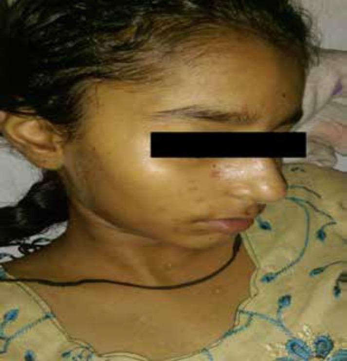 Clinical photograph of a pediatric patient's face and upper neck demonstrating a pleomorphic skin eruption characteristic of varicella-zoster virus (chickenpox) infection. The image shows multiple small lesions in varying stages of evolution, including erythematous and reddish-brown maculopapules, crusting lesions with scab formation, and small residual hypopigmented macules indicating sites of previous inflammation. The lesions are distributed across the cheek, nose, and neck. This variety of lesion stages (the 'starry sky' appearance) is a hallmark diagnostic feature of varicella, representing a synchronous evolution of the rash over several days. The educational focus is on identifying clinical dermatology signs and understanding the progression of viral exanthems in pediatric medicine.