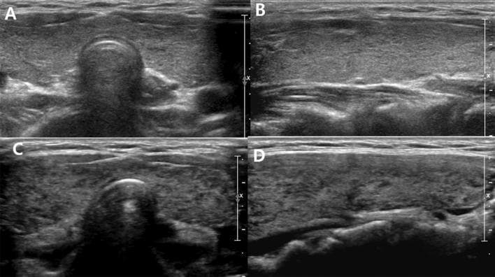 Diagnostic ultrasound comparison of the thyroid gland in a 16-year-old female patient, demonstrating the progression of autoimmune thyroid disease over two years. The image consists of four panels: transverse (A) and longitudinal (B) views from the initial scan, and transverse (C) and longitudinal (D) views from the two-year follow-up. Initial images (A, B) show a diffusely enlarged thyroid gland with mild heterogeneity involving less than one-third of the parenchyma (Grade 2), maintaining relatively normal echogenicity. The follow-up images (C, D) demonstrate marked progression (Grade 4), characterized by severe diffuse heterogeneity and pronounced hypoechogenicity, where the thyroid tissue appears darker than the adjacent strap muscles. These visual changes correlate with the clinical transition from a euthyroid state to overt hyperthyroidism. The series serves as an educational example of how ultrasonographic features like echogenicity and parenchymal texture can be used to grade the severity of thyroid dysfunction in conditions such as Graves' disease or Hashimoto's thyroiditis.
