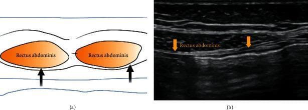 This dual-panel educational figure illustrates the Rectus Sheath Block (RSB), a regional anesthesia technique. Panel (a) is a schematic diagram showing a transverse cross-section of the anterior abdominal wall. It highlights the bilateral rectus abdominis muscles in orange, with black arrows indicating the target needle placement for local anesthetic infiltration into the potential space between the posterior rectus sheath and the muscle. Panel (b) shows a corresponding ultrasound image in the transverse plane lateral to the umbilicus. The rectus abdominis muscle is clearly visualized as a hypoechoic (darker) elliptical structure. Orange arrows point to the hyperechoic (brighter) fascial plane of the posterior rectus sheath, which serves as the injection point for the anesthetic solution. This visual is designed to teach medical professionals how to identify anatomical landmarks for ultrasound-guided abdominal wall blocks, focusing on the interface between the posterior rectus sheath and the rectus abdominis muscle.