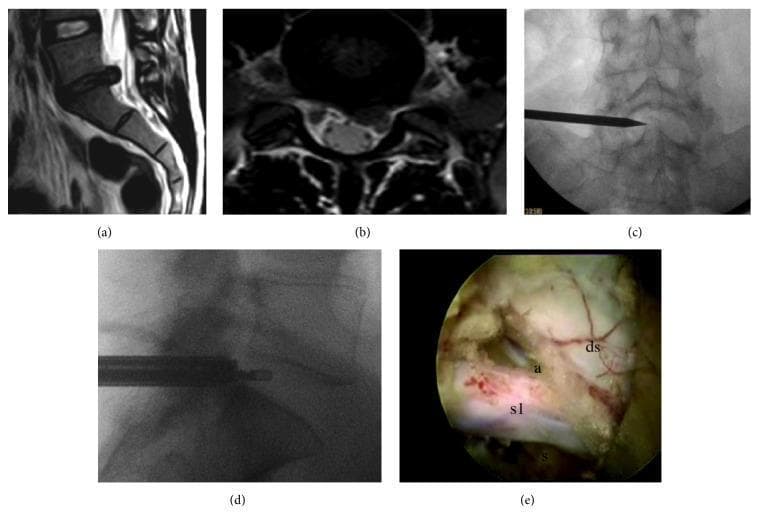 This composite figure illustrates the surgical management of a lumbar disc herniation. Panels (a) and (b) present preoperative T2-weighted sagittal and axial MRI scans, demonstrating an L5-S1 disc herniation causing significant compression of the left S1 nerve root. Panels (c) and (d) provide intraoperative fluoroscopic images of a transforaminal approach. The anteroposterior view (c) shows a surgical pointer identifying the L5-S1 interlaminar window, while the lateral view (d) depicts a radiofrequency bipolar endoscopic probe positioned within the intervertebral disc space. Panel (e) is an intraoperative endoscopic clinical photograph following discectomy. It reveals the decompressed neural structures, with clear labels for the dural sac (ds), the S1 nerve root (s1), and the root's specific anatomical landmarks: the axilla (a) and the shoulder (s). This sequence provides a comprehensive educational overview of preoperative diagnosis, intraoperative localization, and the final surgical outcome of endoscopic lumbar decompression.