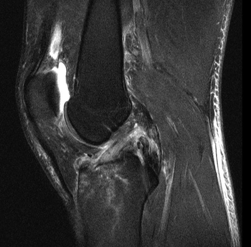 This sagittal T2-weighted fluid-sensitive MRI of the human knee demonstrates multi-ligamentous injury. The image shows a complete rupture of the posterior cruciate ligament (PCL), characterized by clear discontinuity of the fibers and retraction of the proximal segment near its femoral origin. Significant hyperintense signal edema and hemorrhage are visible surrounding the expected PCL location. The anterior cruciate ligament (ACL) follows a continuous anatomical course but exhibits altered internal signal intensity and fiber irregularity suggestive of a partial tear. Additionally, there is evidence of extensive bone marrow edema (trabecular microfracture) within the posterior tibial plateau and a joint effusion in the suprapatellar bursa. This diagnostic image is representative of high-energy knee trauma, illustrating the radiological findings necessary for evaluating acute ligamentous instability and structural disruption in orthopedic and musculoskeletal radiology.