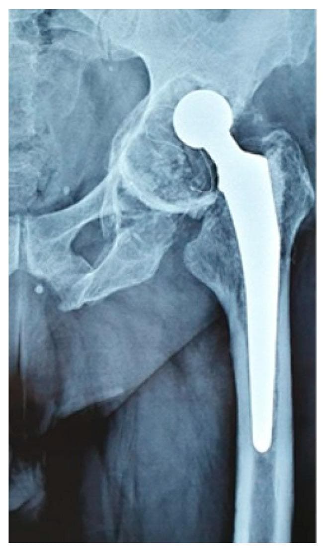 Anteroposterior (AP) pelvis radiograph showing a failed total hip arthroplasty (THA) in the left hip. The image highlights significant periprosthetic pathology, specifically massive acetabular bone loss consistent with a high-grade Paprosky classification. There is evidence of aseptic loosening of the acetabular cup, characterized by prominent radiolucent lines at the bone-implant interface and superior migration of the component. The native acetabular contour is irregular and indistinct, indicating extensive bone resorption and rarefaction, particularly at the superior and medial walls. The femoral component consists of a cemented self-locking femoral stem and a femoral head; the stem appears relatively stable, though the proximal femoral bone stock shows mild signs of remodeling. This diagnostic image illustrates the clinical challenge of revision hip arthroplasty in the setting of severe osteolysis and implant failure, serving as an educational example of mechanical instability and compromised bone quality in orthopedic surgery.