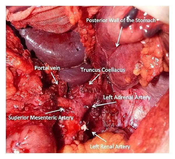 This clinical photograph provides an intraoperative view of the retroperitoneum and upper abdominal cavity following an extensive en bloc tumor resection. The image displays critical vascular anatomy and organ structures with white labels and arrows. Centrally, the celiac trunk (truncus coeliacus) is shown after resection of its primary branches. Positioned superiorly is the portal vein, visible as a large caliber vessel. The superior mesenteric artery is identified inferior to the celiac origin. In the lower portion of the surgical field, the left renal artery and a small left adrenal artery are visualized. To the right of the vessel complex, the posterior wall of the stomach is visible after partial gastrectomy. The surgical field exhibits evidence of multi-organ resection, including distal pancreatectomy and splenectomy, with extensive mobilization of the retroperitoneal tissue. This image is a high-level educational resource for oncological surgery, demonstrating the complex relationships of the mesenteric and celiac vasculature during major abdominal tumor debulking.