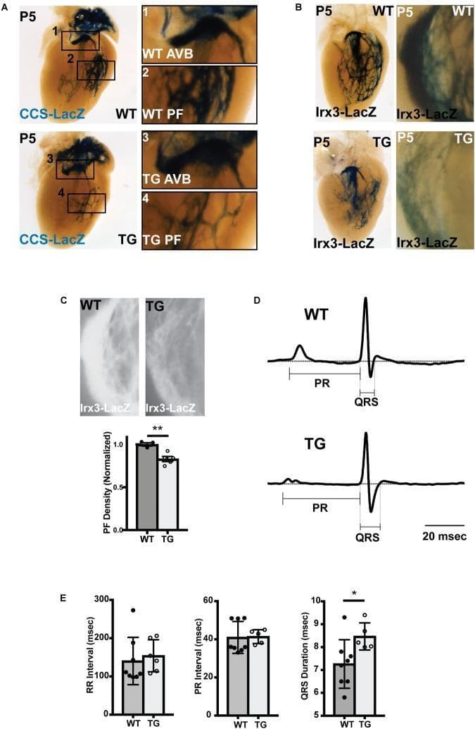 Educational medical graphic illustrating abnormal ventricular conduction system (VCS) structure and electrophysiology in a mouse model of miR-1 overexpression. Panel A shows whole-mount P5 neonatal hearts with CCS-LacZ reporter activity; magnified views compare wild-type (WT) and transgenic (TG) atrioventricular bundles (AVB) and Purkinje fibers (PF), revealing significantly reduced PF branching in TG hearts. Panel B utilizes Irx3-LacZ staining to further demonstrate diminished PF density in the left bundle branch and right ventricle of TG mice. Panel C provides quantification, with a bar graph showing a statistically significant decrease in normalized PF density (p < 0.01). Panel D displays averaged lead aVF ECG tracings, highlighting a prolonged QRS duration in TG mice compared to WT. Panel E includes bar graphs of cardiac intervals (RR, PR, and QRS), confirming that while heart rate and AV node conduction are unchanged, VCS conduction is significantly slowed, as evidenced by increased QRS duration (p < 0.05). This composite figure demonstrates that premature miR-1 upregulation leads to Purkinje fiber hypoplasia and conduction dysfunction.