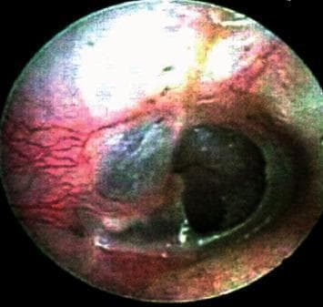 This clinical photograph, captured via otoendoscopy, displays a preoperative view of a human tympanic membrane (eardrum) with a significant central perforation. The perforation is characterized by a well-defined, dark circular void, revealing the underlying middle ear space. The remaining tympanic membrane tissue exhibits marked erythema and increased vascularity, particularly evident in the posterior-superior quadrant, indicating active inflammation or chronic myringitis. The mucosal surface appears thickened and irregular in texture, losing its normal pearly-gray translucency. This image serves as a clinical representation of chronic suppurative otitis media or traumatic perforation, demonstrating the typical morphological changes that necessitate surgical intervention, such as tympanoplasty. The visual highlights key diagnostic features including the size and location of the defect and the health of the surrounding residual membrane, which are critical for surgical planning in otolaryngology.
