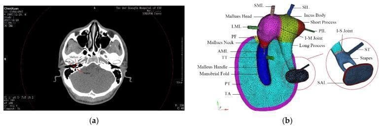 This figure presents a comparative overview of human middle ear anatomy through diagnostic imaging and biomechanical modeling. Image (a) is a clinical axial CT scan of the head at the level of the temporal bone, highlighting the cranium, nasal cavity, and middle ear structures. Specific labels identify the malleus and stapes within the tympanic cavity. Image (b) shows a high-fidelity finite element model of the human middle ear, providing a detailed anatomical diagram of the ossicular chain, ligaments, and tympanic membrane. The model uses color-coding to differentiate structures: the tympanic membrane is shown with its pars tensa (PT) and pars flaccida (PF), bordered by the tympanic annulus (TA). The ossicles are segmented into the malleus head (pink), incus body (green), and stapes (light blue). Key supporting structures are annotated, including the superior, lateral, and anterior mallear ligaments (SML, LML, AML), the superior and posterior incudal ligaments (SIL, PIL), the tensor tympani (TT), and the stapedial annular ligament (SAL). A magnified inset details the incudostapedial (I-S) joint and stapedial tendon (ST).