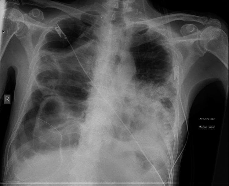 An anteroposterior (AP) chest X-ray demonstrates severe pulmonary parenchymal destruction and complex complications. Key findings include extensive bilateral ground-glass opacities and dense consolidations throughout both lung fields. Multiple large, thin-walled radiolucent structures consistent with cavitations or pneumatoceles are visible, particularly in the right mid-to-lower zones. A right-sided pneumothorax is present, evidenced by a visible pleural line and an absence of lung markings peripherally. A radiopaque intercostal chest drain is in situ on the right side, positioned to manage the pneumothorax. A large right-sided pleural effusion is noted at the base, obscuring the right costophrenic angle and hemidiaphragm. The left lung also shows significant consolidation and reticular opacities. Externally, ECG electrodes are visible on the chest wall. The imaging is consistent with severe pulmonary disease, such as advanced COVID-19 pneumonia complicated by cavitation, pneumothorax, and effusion.
