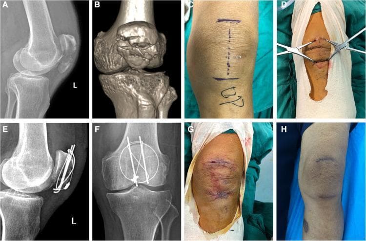 This composite panel illustrates the surgical management and healing progression of a comminuted patellar fracture in a 73-year-old patient. The diagnostic phase includes a lateral radiograph (A) and 3D CT reconstruction (B), demonstrating a displaced fracture with articular discontinuity. Intraoperative photographs show the minimally invasive technique: preoperative skin markings for dual transverse incisions (C), and the application of two-pointed bone reduction forceps (D). Postoperative radiographs (E, F) in lateral and anteroposterior views confirm successful fracture reduction and internal fixation using a combination of vertical Kirschner wires and a figure-of-eight tension-band titanium cable system. The clinical photographs document the wound healing timeline: (G) shows the immediate postoperative appearance with fresh sutures and localized ecchymosis, while (H) shows the three-month follow-up where the two small transverse scars are well-healed, showing minimal erythema and significant resolution of surrounding bruising. This series highlights orthopedic surgical principles including anatomical reduction, stable internal fixation, and the benefits of minimally invasive approaches in elderly populations.