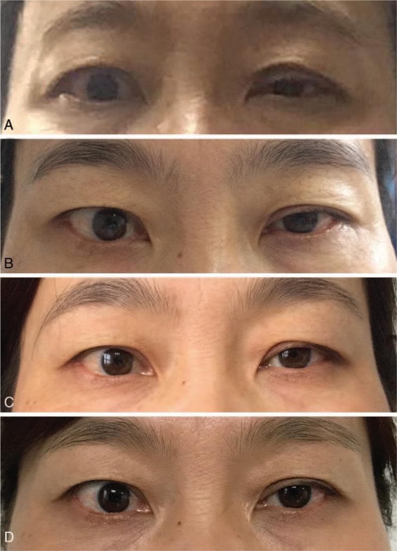 A series of four clinical photographs (A-D) demonstrating the longitudinal progression and recovery of left-sided Horner syndrome in a female patient over a one-year postoperative period. Image A (2 days postoperative) shows the classic triad of ptosis (drooping of the upper eyelid), miosis (constricted pupil), and apparent enophthalmos (sunken eye) on the left side compared to the normal right eye. Image B (one month) and Image C (six months) illustrate a gradual recovery of eyelid elevation and pupillary dilation. Image D (one year) displays a near-complete resolution of symptoms with restoration of ocular symmetry, though a slight residual ptosis may remain. The images serve as an educational timeline for the spontaneous or medically managed recovery of iatrogenic Horner syndrome following neck surgery, such as thyroidectomy. The progression highlights the clinical features of sympathetic pathway disruption and the objective markers used to track neurologic recovery of the oculosympathetic fibers.