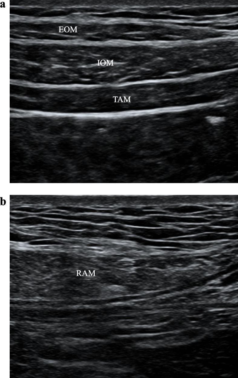 This diagnostic image consists of two high-frequency ultrasound panels (a and b) illustrating the anatomy of the anterior and lateral abdominal wall for regional anesthesia planning. Panel A demonstrates a transverse view of the lateral abdominal wall, showing three distinct muscle layers separated by hyperechoic fascial planes: the superficial external oblique muscle (EOM), the middle internal oblique muscle (IOM), and the deep transversus abdominis muscle (TAM). Below the TAM, a prominent hyperechoic line marks the transversus abdominis plane (TAP), a key landmark for TAP blocks. Panel B displays a transverse view of the rectus abdominis muscle (RAM), characterized by a striated, heterogeneous echotexture with visible internal fascial echoes. The image shows the interface between the RAM and the posterior rectus sheath, which is the target area for a rectus sheath block (RSB). Both images serve as educational references for identifying ultrasound-guided needle insertion sites for postoperative analgesia in abdominal surgery.