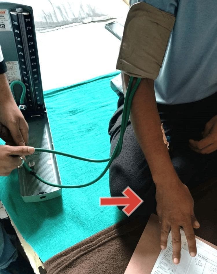 This clinical photograph demonstrates Trousseau’s sign of latent tetany in a patient. The image shows the patient's right arm with a blood pressure cuff inflated on the upper arm. The resulting carpopedal spasm is clearly visible, characterized by flexion of the wrist, flexion of the metacarpophalangeal joints, adduction of the thumb, and hyperextension of the interphalangeal joints, often referred to as 'main d'accoucheur' or obstetrician's hand. To the left, a healthcare worker is shown operating a vertical mercury-style sphygmomanometer (mercury-free design) with green tubing connected to the cuff. The medical context indicates this sign was elicited during a routine physical examination and is highly suggestive of hypocalcemia, often associated with conditions such as hypoparathyroidism. The photograph serves as a classic educational example of neuromuscular irritability triggered by transient ischemia from the inflated cuff.