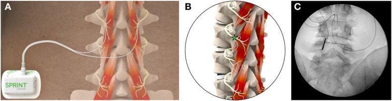Educational panel illustrating percutaneous peripheral nerve stimulation (PNS) for chronic low back pain. Panel A is a clinical diagram showing a body-worn stimulator (SPRINT system) connected to two fine-wire leads targeting the paraspinal muscles of the lumbar spine. Panel B provides an anatomical illustration of the lumbar vertebrae and paraspinal musculature in an oblique view, highlighting the target location (green star) where the medial branches of the dorsal rami course over the lamina, medial and inferior to the facet joint, to innervate the multifidus muscles. Panel C is an anteroposterior (AP) fluoroscopic diagnostic image demonstrating the intraprocedural placement of a radiopaque introducer needle and lead. The lead is positioned adjacent to the vertebral lamina, confirming appropriate clinical targeting for medial branch stimulation. This content is designed for pain management specialists and radiologists to understand the technical and anatomical approach for treating axial chronic low back pain via neuromodulation.