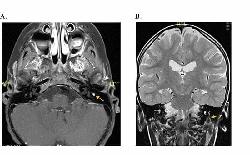 Diagnostic neuroimaging featuring two T1-weighted post-contrast MRI views focusing on the internal auditory canal and facial nerve (Cranial Nerve VII). Panel A (Axial view) demonstrates abnormal focal enhancement of the left facial nerve at the level of the geniculate ganglion, indicated by a yellow arrow, visible against the surrounding temporal bone and cerebellum. Panel B (Coronal view) shows linear enhancement and asymmetric enlargement of the descending mastoid segment of the left facial nerve, extending from the geniculate ganglion toward the stylomastoid foramen, also marked by a yellow arrow. Comparison with the contralateral right side reveals significant hyperintensity and thickening on the left. These findings are clinically significant in the diagnostic workup of facial nerve pathology, such as Bell's palsy or facial nerve schwannoma. General neuroanatomical structures including the lateral ventricles, temporal lobes, and brainstem are also visible.