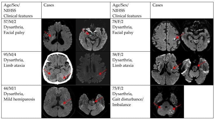 A diagnostic imaging compilation featuring axial Diffusion-Weighted Imaging (DWI) scans and a CT scan from six different patient cases diagnosed with acute ischemic stroke or transient ischemic attack (TIA). Each case includes clinical metadata such as age, sex, National Institutes of Health Stroke Scale (NIHSS) score, and key neurological symptoms (e.g., dysarthria, facial palsy, limb ataxia, hemiparesis). Red arrows highlight acute infarcts, which appear as hyperintense (bright) signals on DWI or hypodense areas on CT. The collection demonstrates a variety of lesion patterns: Case 1 and 4 show cortical/subcortical focal infarcts in the frontal and parietal lobes; Case 2, 3, 5, and 6 exhibit multiple territorial or infratentorial lesions, including bilateral cerebellar involvement and brainstem (pontine) infarcts. The image serves as an educational tool for correlating stroke topography with clinical presentations of prominent dysarthria and multifocal vascular events, highlighting common locations such as the cerebellum and various cortical regions.
