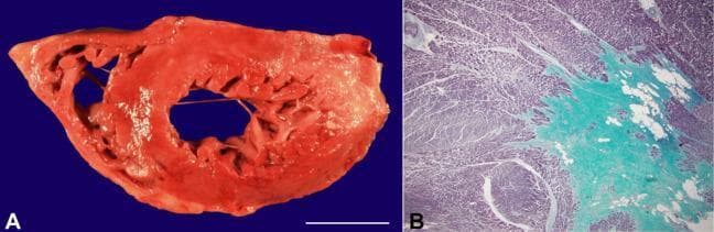 This composite educational resource demonstrates the pathology of chronic myocardial infarction through gross and microscopic examination. Image A is a clinical photograph showing a fresh transverse section of the human heart at the ventricular level. The myocardium exhibits a predominantly reddish-brown hue with visible transmural thinning and whitish, fibrotic scarring in the lateral and posterior walls of the left ventricle. A focal area of subendocardial fibrosis is also visible in the anterior ventricle. A 3 cm scale bar is included for morphometric reference. Image B is a light microscopy image at 20x magnification using Gomori trichrome stain, which highlights tissue composition. The viable cardiomyocytes are stained reddish-purple, while dense collagenous scar tissue (fibrosis) is stained bright blue-green, illustrating the replacement of necrotic muscle fibers with connective tissue. This finding is characteristic of a remote or healed myocardial infarct. This material is suitable for cardiovascular pathology education, illustrating the progression from myocardial injury to permanent scarring and ventricular remodeling.