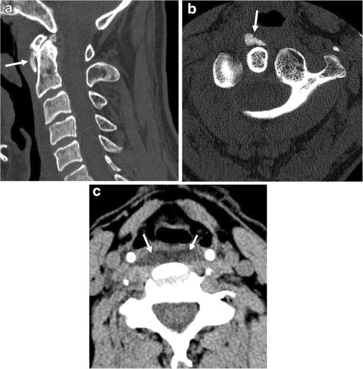 This composite diagnostic image features three non-contrast CT scans of the cervical spine in sagittal (a) and axial (b, c) planes, illustrating Acute Calcific Longus Colli Tendinitis (also known as prevertebral calcific tendinitis). Panel (a) and (b) highlight dense, amorphous calcifications (white arrows) located at the superior myotendinous junction of the longus colli muscle, specifically at the C1-C2 level anterior to the atlas and axis. Panel (c) is an axial soft-tissue window demonstrating significant prevertebral soft-tissue swelling and symmetric edema (white arrows) outlining the anterior margin of the bilateral longus colli muscles. This combination of pathognomonic amorphous calcification and prevertebral fluid/edema is typical of this inflammatory condition. The images are essential for distinguishing this self-limiting clinical entity from more serious conditions like retropharyngeal abscess. The content is suitable for radiology education, focusing on emergency medicine and musculoskeletal diagnostic imaging.