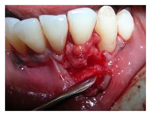 This intraoral clinical photograph illustrates an intermediate stage of a periodontal plastic surgery procedure for root coverage. The image shows the mandibular anterior region, specifically tooth number 32 (lower left lateral incisor), which presents with Miller's class II gingival recession. A subepithelial connective tissue graft (SCTG) has been harvested and positioned over the denuded root surface. The surgical site displays a reflected partial-thickness flap with mesial and distal vertical releasing incisions. The adjacent papillary grafts from the interdental spaces are being manipulated and sutured midbuccally over the graft to provide a double pedicle covering. A metallic surgical periosteal elevator is visible at the inferior aspect of the site, reflecting the mucosal flap. The surrounding gingiva appears erythematous and edematous, consistent with acute surgical trauma and inflammation. Visible 5-0 sutures are used to stabilize the graft and approximate the tissue margins. This image demonstrates the clinical application of a combined SCTG and double pedicle flap technique for correcting localized gingival recession and increasing the zone of keratinized tissue.