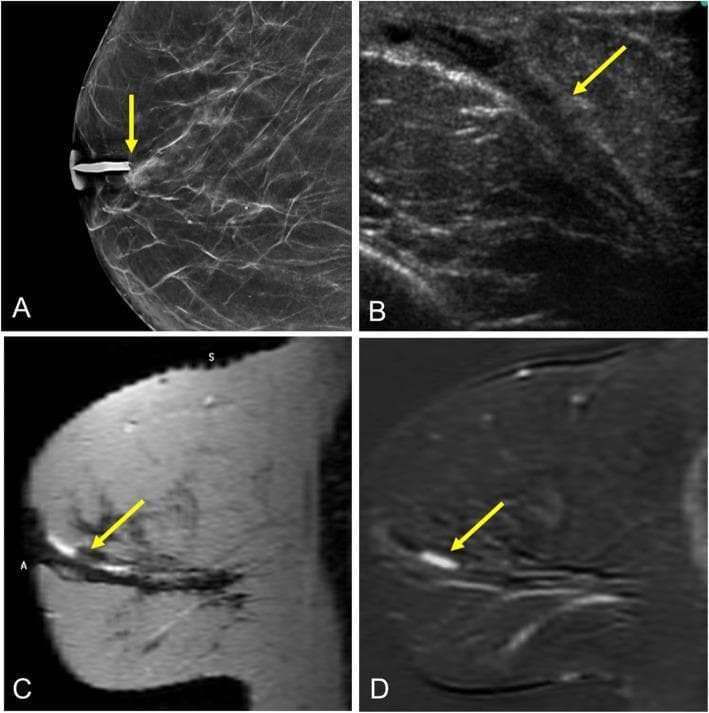 This composite of diagnostic breast imaging features a case of solitary intraductal papilloma in a 65-year-old woman. Image A is a craniocaudal ductogram (galactogram) showing a concave filling defect (arrow) within a contrast-filled duct, located approximately 2 cm posterior to the nipple. Image B is a grayscale ultrasound demonstrating ductal ectasia containing a corresponding hypoechoic intraductal lesion (arrow). Image C is a sagittal T2-weighted MRI revealing hyperintense signal within a dilated duct (ductal ectasia) containing a low-signal intraductal mass (arrow). Image D is a sagittal contrast-enhanced T1-weighted subtracted MRI showing the lesion (arrow) with focal, differential contrast enhancement compared to surrounding tissue. Collectively, these modalities illustrate the diagnostic approach to pathological nipple discharge, highlighting the appearance of a benign papillary lesion across x-ray, ultrasound, and magnetic resonance imaging platforms.