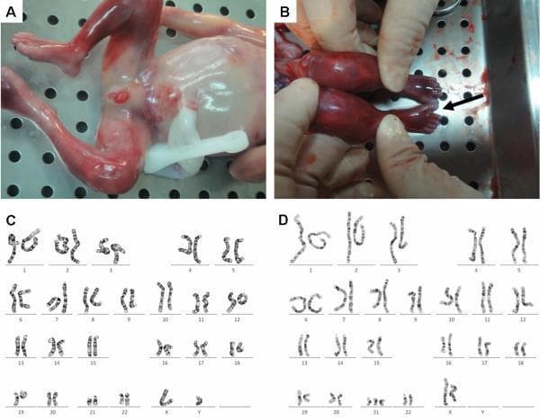 This composite educational image illustrates the phenotypic and genotypic findings of a chimeric fetus with sex-chromosome discordant trisomy 21. Panel A shows a clinical photograph of the lower trunk and perineum of an aborted fetus, demonstrating phenotypically normal male external genitalia with visible cryptorchidism (undescended testes). Panel B provides a close-up view of the fetal foot where a black arrow highlights a wide space between the first and second toes, known as a 'sandal gap' deformity, a soft marker for Down syndrome. Panels C and D display G-banded karyotypes identifying two distinct cell lines within the same individual: Panel C shows a normal male karyotype (46,XY), and Panel D shows a female karyotype with trisomy 21 (47,XX,+21). The collection demonstrates the clinical presentation of chimerism, where anatomical development may not fully reflect the chromosomal mosaicism/chimerism present in different tissue layers. This material is relevant for medical genetics and embryology education focusing on chromosomal abnormalities and mosaicism.
