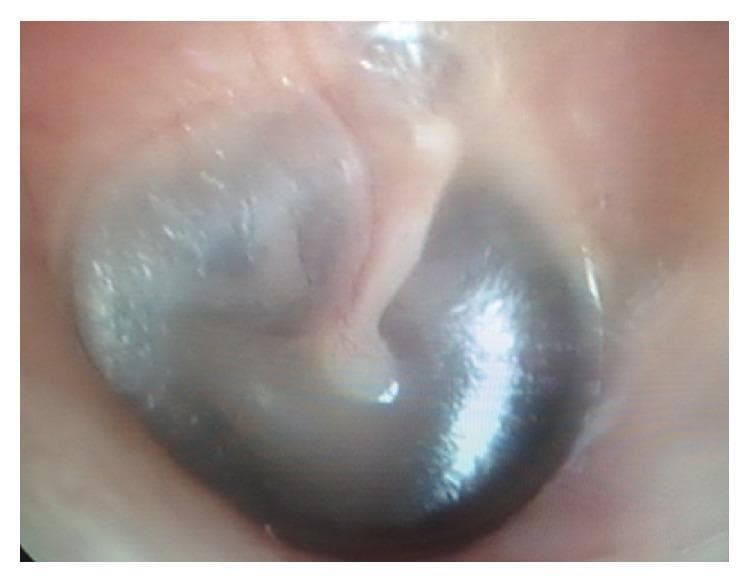 This clinical photograph displays a close-up view of a human tympanic membrane (eardrum) captured during an otoscopic examination. The imaging modality is clinical otoscopy. The tympanic membrane exhibits a generally pearly-gray to slightly translucent appearance in the superior regions, while the inferior portion shows darker, shadowed areas. Key anatomical landmarks are visible, including the manubrium of the malleus extending from the superior periphery toward the umbo at the center of the membrane. The external auditory canal wall surrounding the membrane appears healthy, with a smooth, pinkish-flesh tone and no signs of acute inflammation, erythema, or obstructive cerumen. This image serves as an educational example of a normal otoscopic finding or a baseline clinical assessment in a patient presenting with otalgia, illustrating the standard morphology and positioning of the middle ear structures as seen through the ear canal.