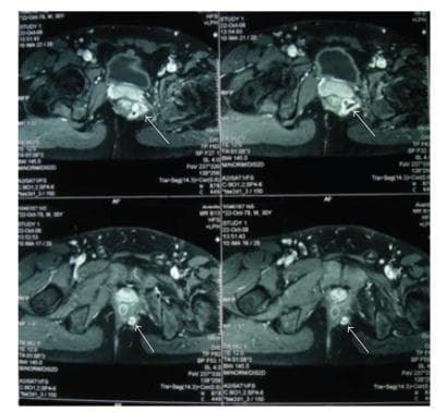 Axial pelvic Magnetic Resonance Imaging (MRI) scans demonstrate a complex suprasphincteric fistula in ano with associated abscess formation. The series of T2-weighted or contrast-enhanced images shows a high-signal-intensity fluid collection representing an abscess cavity, approximately 2 cm in diameter, located superior to the levator ani muscle. White arrows indicate the fistula tract, which presents as a distinct linear pathway of altered signal intensity extending from an internal opening in the rectum through the pelvic musculature toward the perianal region. The images highlight the relationship between the inflammatory process and key anatomical landmarks, including the rectum, levator ani, and perianal soft tissues. This diagnostic imaging is characteristic of complex perianal disease, showing both the localized suppuration (abscess) and the extensive 10 cm fistulous tract. Such findings are critical for surgical planning in cases of deep pelvic infections or complex fistula management.