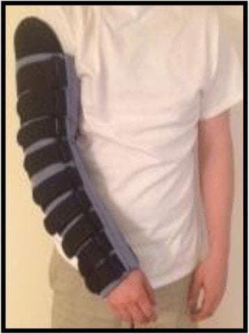 This clinical photograph displays a strapped Night-time Compression System Garment (NCSG) applied to the right upper extremity of a patient. The device is designed for the management of breast cancer-related lymphedema. The garment extends from the proximal upper arm to the wrist, featuring a dual-layer construction: a light-colored, padded foam liner that provides soft interface against the skin, and an overlying series of multiple, wide, dark-colored inelastic straps. These straps are arranged horizontally and use a hook-and-loop fastening mechanism (Velcro) to allow for precise adjustment of compression levels along the limb. The system facilitates the application of gentle gradient pressure, promoting lymphatic drainage while maintaining low resting pressure suitable for overnight use. This visual serves as an educational example of alternative self-management strategies to traditional multilayer compression bandaging (CB), emphasizing ease of application and customizable fit for patients with varying degrees of swelling.