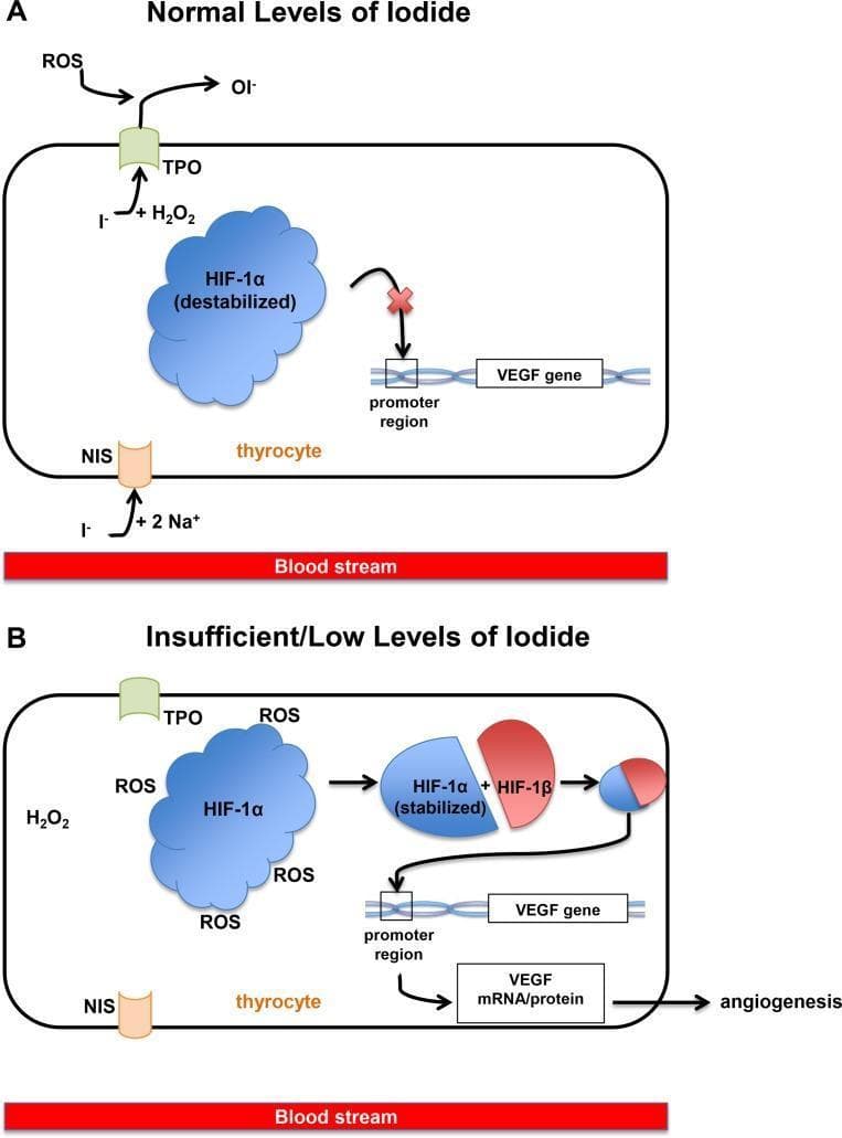 This pathophysiology diagram illustrates the molecular signaling pathways in a thyrocyte under normal (Panel A) versus insufficient iodide conditions (Panel B). In both scenarios, the basolateral membrane shows iodide (I-) entry via the sodium-iodide symporter (NIS). Panel A depicts normal iodide levels where I- reacts with thyroid peroxidase (TPO) and H2O2 at the apical membrane. In this state, Hypoxia Inducible Factor-1α (HIF-1α) is destabilized and unable to bind to the Vascular Endothelial Growth Factor (VEGF) gene promoter, indicated by a red 'X'. Panel B illustrates iodine deficiency, where lack of I- substrate results in high levels of cytoplasmic Reactive Oxygen Species (ROS). These ROS stabilize HIF-1α, facilitating its dimerization with HIF-1β. The resulting heterodimer binds to the VEGF gene promoter, stimulating the transcription and translation of VEGF mRNA/protein. This molecular cascade leads to the clinical outcome of angiogenesis. The diagram highlights how iodine deficiency can independently induce thyroid vascularization via the HIF-1α/VEGF pathway.