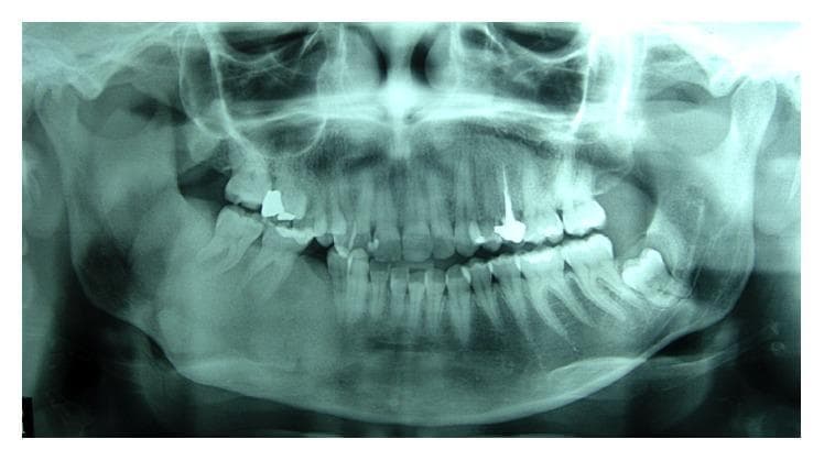 This panoramic dental radiograph (orthopantomogram) displays a significant pathological alteration in the right hemimandible. The primary finding is a large, poorly defined radiopaque lesion with a characteristic 'ground glass' appearance, which has replaced the normal trabecular bone pattern. This appearance is highly suggestive of fibrous dysplasia. The lesion extends through the mandibular body on the right side, causing an apparent increase in bone volume and density. Dental findings include evidence of previous restorative and endodontic treatments, visible as radiopaque fillings and a root canal post. There is also evidence of tooth extractions in the posterior right mandible, indicated by missing dentition in the affected area. The maxillary and contralateral mandibular structures appear relatively normal, providing a comparative baseline for the density of the pathology. This diagnostic image is used to monitor the progression or recurrence of fibro-osseous lesions in a clinical dental or maxillofacial context.
