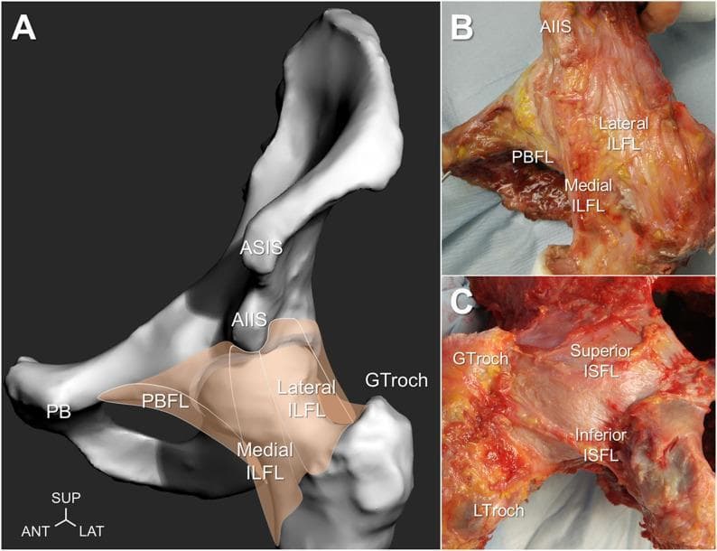 This composite educational image illustrates the anatomy of the human hip joint's capsular ligaments. Part A shows a 3D anatomical diagram of a left hip model in a neutral position, highlighting the iliofemoral ligament (ILFL) with its lateral and medial branches, and the pubofemoral ligament (PBFL). Part B is a clinical photograph of a cadaveric specimen from an anterior view in external rotation, demonstrating the distinct fibrous bands of the lateral and medial ILFL originating from the anterior inferior iliac spine (AIIS), alongside the medially located PBFL near the pubis. Part C is a posterior cadaveric view of the hip in internal rotation, showcasing the ischiofemoral ligament (ISFL). It reveals the differentiation between the Superior ISFL, which runs horizontally toward the greater trochanter (GTroch), and the Inferior ISFL, which has an oblique orientation toward the lesser trochanter (LTroch). The images emphasize the complex arrangement of these primary ligaments and their roles in providing mechanical stability and restricting rotational motion of the hip joint.