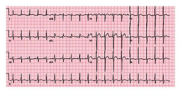 A 12-lead electrocardiogram (ECG) recorded at a heart rate of approximately 115 bpm, demonstrating a narrow QRS complex tachycardia. The QRS complexes are within normal duration (<120 ms) across all leads. P-wave morphology is distinctive, showing negative deflection (inversion) in leads II and aVL, while remaining upright (positive deflection) in leads III and aVF. These findings are clinically significant as they suggest a non-sinus atrial origin for the rhythm, specifically an ectopic atrial tachycardia likely originating from the left atrium. The ECG is presented on standard grid paper with standard limb and precordial lead arrangements (I, II, III, aVR, aVL, aVF, and V1-V6), with a rhythm strip of lead II at the bottom. The visual provides a diagnostic example of supraventricular tachycardia for medical educational analysis of P-wave polarity and atrial focus localization.