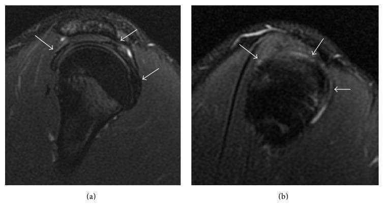 Two sagittal T2-weighted fat-suppressed spin-echo (T2 FS SE) magnetic resonance (MR) images of a right shoulder, labeled (a) and (b), focusing on the rotator cuff anatomy. The images demonstrate the supraspinatus, infraspinatus, and subscapularis tendons (indicated by white arrows) draped over the humeral head. The tendons exhibit characteristic uniform hypointensity and normal thickness, which are hallmark visual indicators of healthy, intact fibrocartilaginous tissue. There is a notable absence of hyperintense signal within the tendon substances or at their insertions, ruling out partial or full-thickness rotator cuff tears, tendinopathy, or significant inflammatory fluid collection in the subacromial-subdeltoid bursa. This diagnostic imaging serves as a clinical reference for normal musculoskeletal anatomy of the shoulder girdle and is used to evaluate the integrity of the rotator cuff in patients presenting with shoulder pain or limited range of motion.