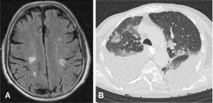 This dual-panel diagnostic image displays multi-organ involvement in a patient with Eosinophilic Granulomatosis with Polyangiitis (Churg-Strauss syndrome). Panel A is an axial MRI scan of the brain (FLAIR sequence) showing multiple hyperintense foci within the subcortical white matter and cortex, primarily in the frontal and parietal lobes, consistent with multiple embolic or vasculitic infarcts. Panel B is an axial CT scan of the thorax in a lung window, demonstrating bilateral, patchy ground-glass opacities and pulmonary infiltrates. Significant fluid accumulation is noted in the pleural spaces bilaterally, representing bilateral pleural effusion. Together, these diagnostic images illustrate the systemic nature of small-to-medium vessel vasculitis, specifically highlighting the neurologic (central nervous system ischemia) and pulmonary (eosinophilic infiltrates and exudative effusion) manifestations of the disease. This content is suitable for medical education regarding rheumatological emergencies and systemic vasculitides.