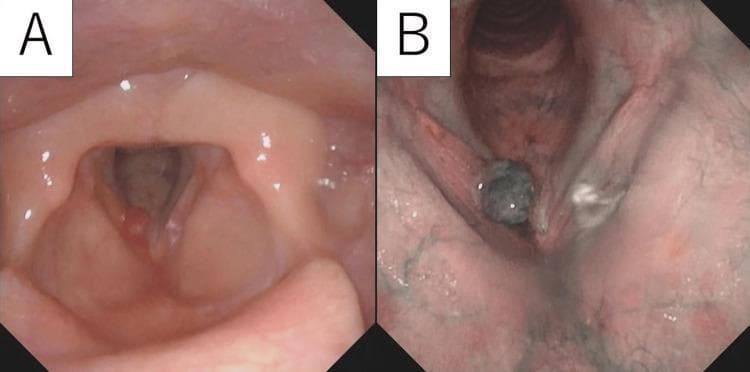 Side-by-side endoscopy images (laryngoscopy) of the larynx comparing White Light (WL) and Narrow-Band Imaging (NBI) modalities for a vocal cord tumor. Image A (WL) shows a pale red, globular, nodular mass with a smooth surface, located on the anterior third of the right vocal cord near the anterior commissure. The contralateral vocal cord appears normal. Image B (NBI) enhances the vascular detail, showing the same mass as dark green with significant internal vascularity and prominent subepithelial vessels in the surrounding mucosa. This comparison demonstrates the utility of NBI in highlighting neovascularization and lesion borders for surgical planning of laryngeal pathologies, such as a cavernous hemangioma. The clinical context involves a patient with chronic hoarseness, and the visual evidence guides the differential diagnosis between benign polyps and vascular tumors.