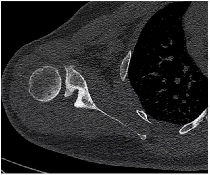 This diagnostic image is an axial CT scan of the right shoulder demonstrating advanced glenohumeral osteoarthritis. The primary finding is a Walch type B2 glenoid, characterized by a biconcave morphology of the glenoid fossa. The image shows a 'paleoglenoid' (the original, more anterior articular surface) and a 'neoglenoid' (the posterior, eroded surface created by chronic wear). This structural remodeling results in a significant posterior subluxation of the humeral head relative to the scapular axis. Key anatomical landmarks visible include the humeral head, the scapular body, and the lateral thoracic wall. The educational focus is on the assessment of glenoid bone loss and version abnormalities, which are critical for preoperative planning in total shoulder arthroplasty. The image serves as a clinical example of how eccentric loading in the shoulder joint leads to asymmetric posterior erosion and joint instability.