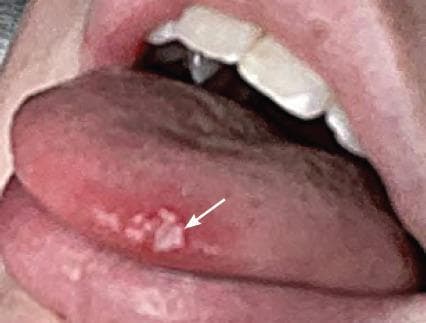 A clinical photograph of the oral cavity focusing on the lateral and dorsal aspect of the tongue, illustrating features of primary herpetic gingivostomatitis. The image demonstrates a cluster of multiple small, discrete, and coalescing whitish-yellow vesicles and ulcers located on the lateral border of the tongue. These lesions are slightly raised with irregular margins. A white arrow highlights a prominent ulcerated area within the cluster. The surrounding mucosa is markedly erythematous and inflamed, providing a sharp contrast to the lighter-colored lesions. This visual represents the acute phase of a viral infection (Herpes Simplex Virus Type 1), focusing on the presentation of painful intraoral vesicles that rupture to form fibrin-covered ulcers. It is a key educational example for dental and medical students in recognizing oral manifestations of primary viral stomatitis and differentiating it from other ulcerative conditions like aphthous ulcers.