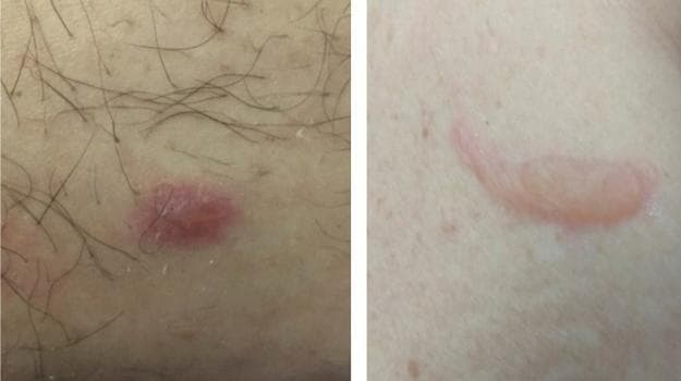 This clinical photograph displays vesico-bullous skin lesions in a patient, categorized as a dermatological manifestation of COVID-19. The image is split into two panels showing different morphological stages. The left panel reveals a small, erythematous, roughly circular vesicle situated on hair-bearing skin. The right panel displays a larger, crescent-shaped bulla. This larger lesion is distinctly elevated and translucent, indicating a fluid-filled subepidermal or intraepidermal space. The surrounding skin in the right panel appears mildly pale but lacks significant peri-lesional inflammation. These lesions represent a varicella-like pattern, which typically appears within the first week of systemic viral symptoms. In a clinical context, such vesico-bullous eruptions are associated with mild to moderate systemic disease and serve as an important diagnostic marker to differentiate COVID-19 related exanthems from other viral or drug-induced reactions.