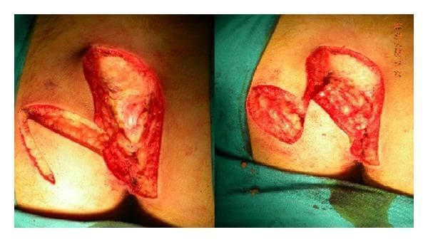 This clinical photograph shows two perspectives of an intraoperative site during pilonidal sinus surgery. The images demonstrate a wide surgical excision in the sacrococcygeal region with the patient in the prone position. An S-shaped oblique incision has been utilized for the initial excision, extending down to the postsacral fascia. Visible in the operative field is a full-thickness, broad-pedicled transposition flap, resembling a Dufourmentel flap, which includes skin, subcutaneous fat, and the fascia over the gluteus maximus. The flap is dissected and reflected to reveal the underlying deep tissue defect and anatomical landmarks, including the reddish gluteal muscle fibers and yellowish lobulated subcutaneous adipose tissue. The incision edges are sharp and clean-cut, indicating precise surgical margins for reconstruction. This visual serves to illustrate the surgical technique for managing complex or wide pilonidal disease by flattening the intergluteal sulcus and moving the eventual scar away from the midline to reduce recurrence risk.