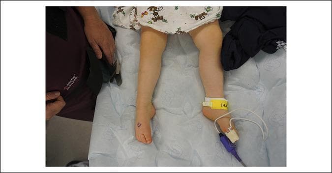 A clinical photograph of a pediatric patient's lower extremities in a supine position, highlighting a comparison between the right and left feet. The patient's right foot exhibits a classic 'foot drop' deformity, characterized by a resting posture of plantarflexion and inversion. This abnormal positioning suggests weakness or paralysis of the ankle dorsiflexors (primarily the tibialis anterior) and evertors, typically associated with common peroneal nerve palsy. In contrast, the left foot maintains a more neutral resting alignment. Visible medical attachments on the right limb include a yellow identification band at the ankle and a pulse oximetry probe secured to the hallux (great toe) with white tape, indicating the patient is undergoing perioperative monitoring. The image serves as a clinical example of lower motor neuron-type paralysis affecting the peroneal distribution, demonstrating how physical exam findings can localize neural compression or injury at the fibular head.