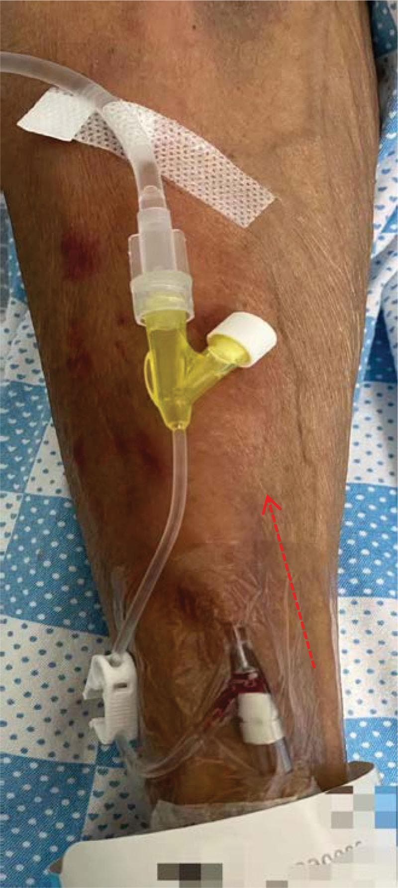This clinical photograph displays a patient's left upper limb during intravenous (IV) infusion, illustrating a localized cutaneous reaction. A prominent area of linear swelling and erythema, measuring approximately 19 cm x 6 cm, is visible along the proximal path of the cephalic vein. The skin surface in this region appears tense and edematous with exaggerated skin markings. The IV apparatus is secured with a transparent film dressing and medical tape. The IV tubing features a Y-connector containing a yellowish fluid, likely a chemotherapy or immunotherapy agent (such as sintilimab). A red dashed arrow indicates the linear progression of the swelling, which is characteristic of an infusion-related reaction or superficial phlebitis. The surrounding skin shows signs of secondary changes, including older ecchymotic patches and a somewhat leathery texture. This image serves as an educational example of monitoring for infusion-related adverse events, such as vascular-tracking hypersensitivity or localized drug-induced swelling, as distinguished from extravasation.