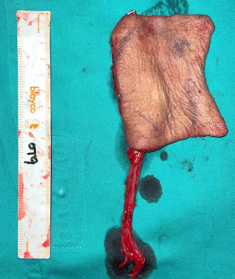 Clinical photograph of a harvested free radial forearm fasciocutaneous (RFFF) flap, commonly used in reconstructive plastic surgery for soft tissue coverage. The image displays a roughly rectangular skin paddle with pale pink to flesh-toned pigmentation and natural skin creases. The flap is oriented vertically on a green sterile surgical drape. Attached to the inferior aspect is a long vascular pedicle, which includes the radial artery and accompanying vena comitans, appearing as a tubular, bright red structure indicative of fresh harvest. A surgical ruler is positioned to the left of the flap to provide a scale for dimension assessment, confirming a size of approximately 9x6 cm. Visible surgical markings and minor bruising are present on the epidermal surface. This image serves as a high-fidelity representation of a microvascular free flap donor site preparation, illustrating the relationship between the cutaneous tissue island and its supplying blood vessels prior to anastomosis at the recipient site, such as for orbital or facial reconstruction.